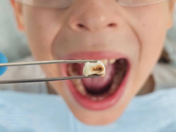 Best Emergency Wisdom Teeth Removal in Kelso, WA